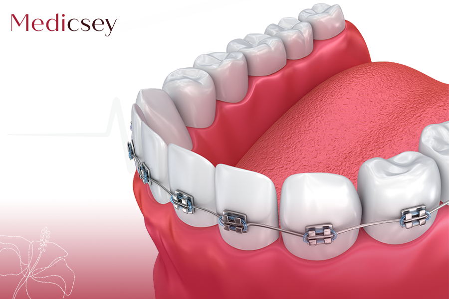 Dental Braces in Turkey Cost, Procedure & Treatment Abroad Medicsey